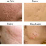 best treatments for acne scarring